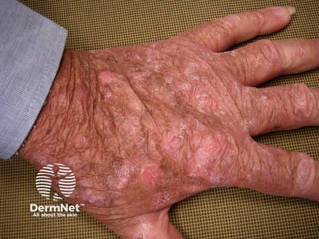 Actinic keratoses affecting the hands