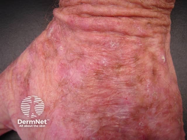 Actinic keratoses affecting the hands