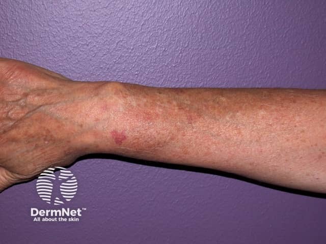 Actinic keratoses affecting the hands