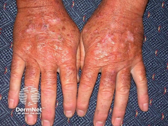 Actinic keratoses affecting the hands