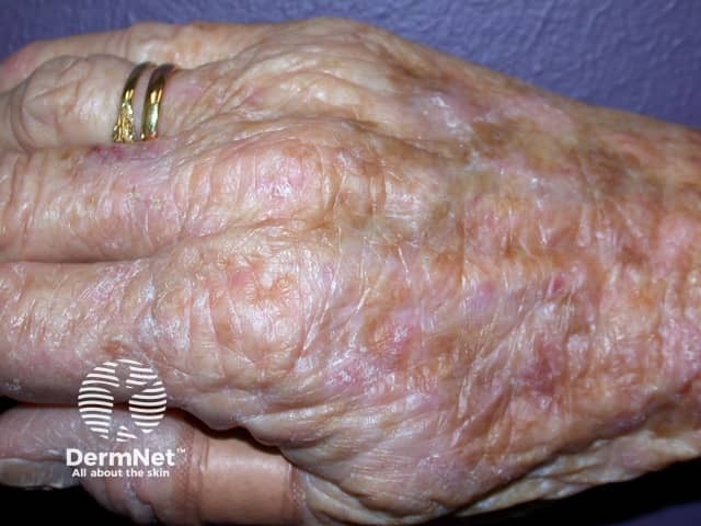 Actinic keratoses affecting the hands