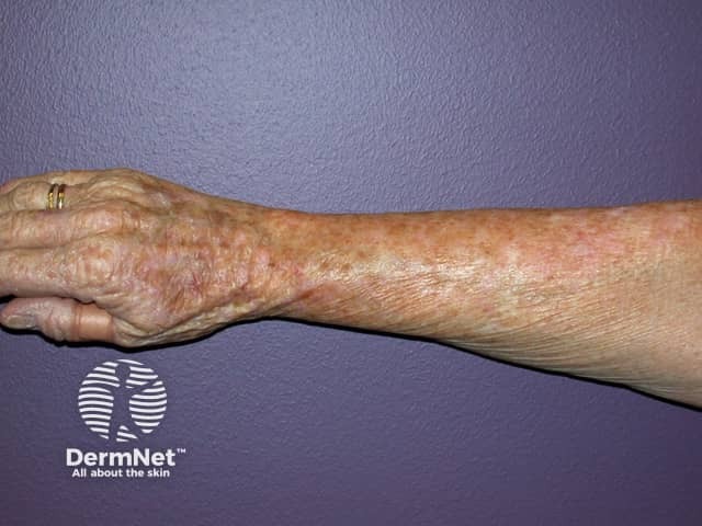 Actinic keratoses affecting the hands