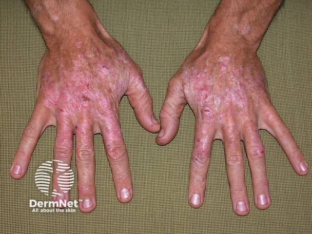 Actinic keratoses affecting the hands