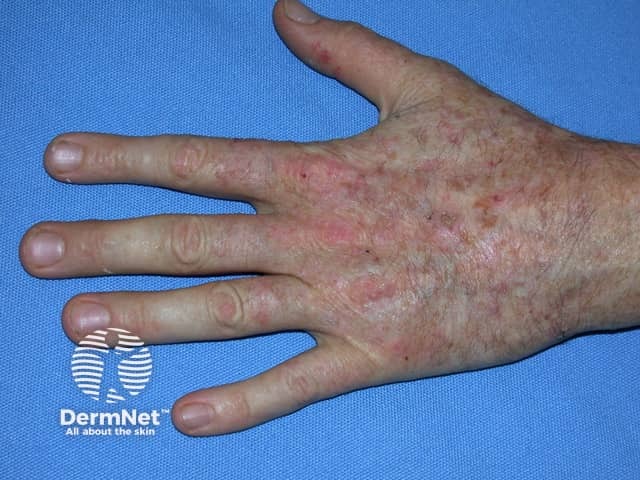 Actinic keratoses affecting the hands