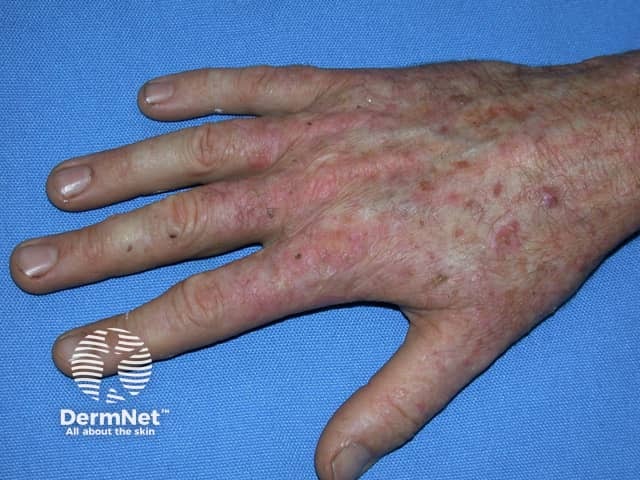 Actinic keratoses affecting the hands