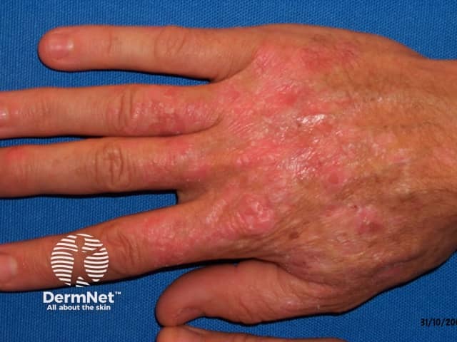 Actinic keratoses affecting the hands