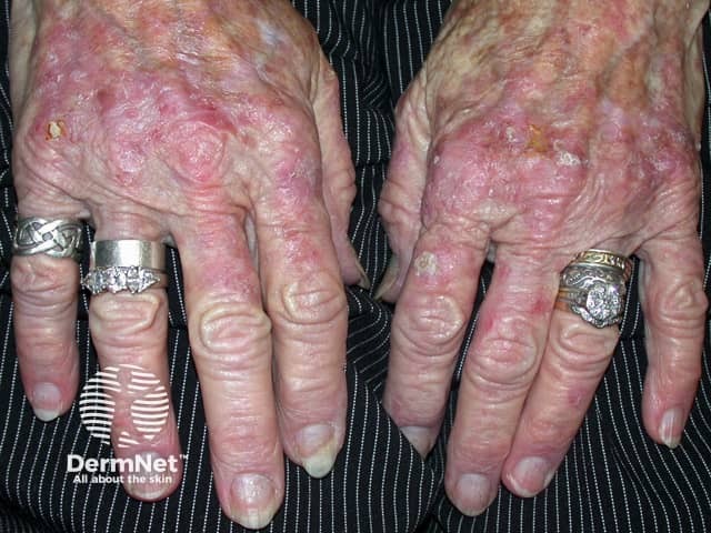 Actinic keratoses affecting the hands