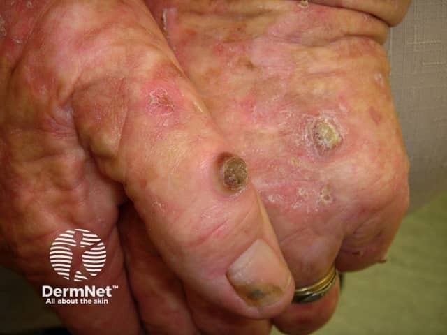 Actinic keratoses affecting the hands