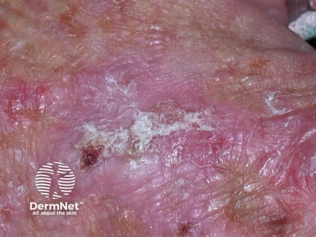 Actinic keratoses affecting the hands