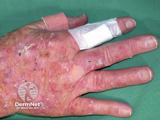 Actinic keratoses affecting the hands