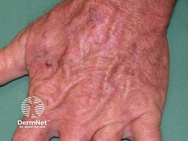 Actinic keratoses affecting the hands