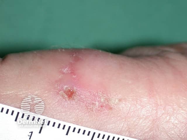 Actinic keratoses affecting the hands