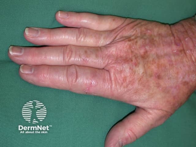 Actinic keratoses affecting the hands