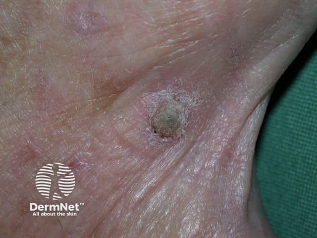 Actinic keratoses affecting the hands