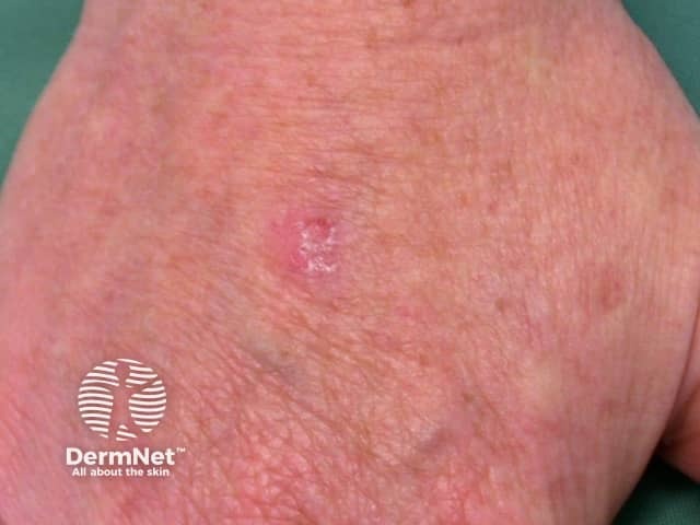 Actinic keratoses affecting the hands