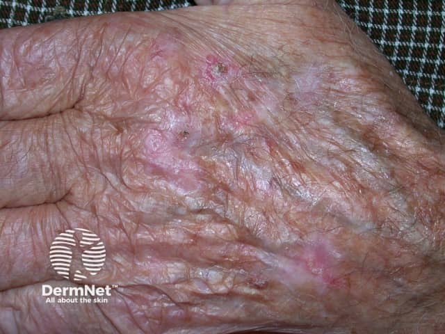 Actinic keratoses affecting the hands