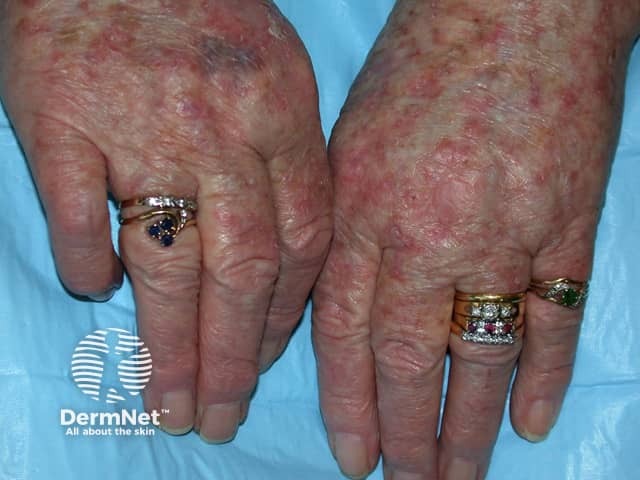 Actinic keratoses affecting the hands