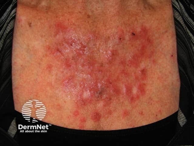 Actinic Keratoses treated with imiquimod