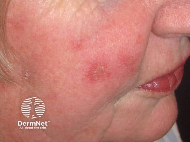 Actinic Keratoses treated with imiquimod