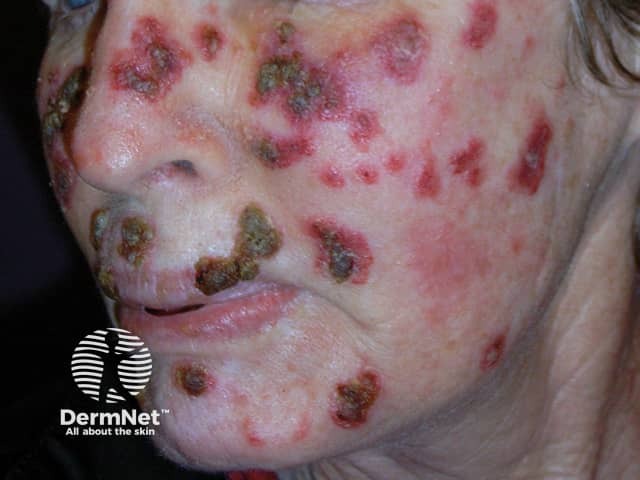 Actinic Keratoses treated with imiquimod