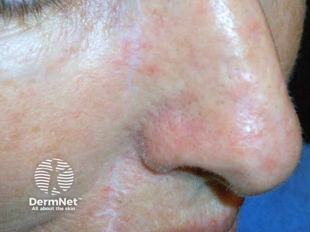 Actinic Keratoses treated with imiquimod