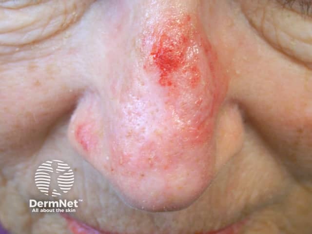 Actinic Keratoses treated with imiquimod