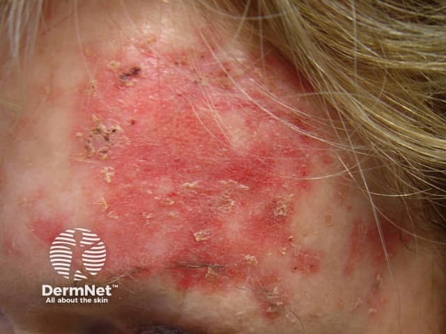 Actinic Keratoses treated with imiquimod