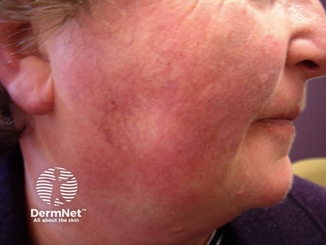 Actinic Keratoses treated with imiquimod