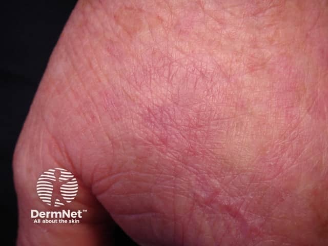 Actinic Keratoses treated with imiquimod