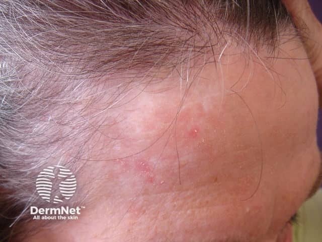 Actinic Keratoses treated with imiquimod