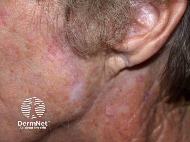 Actinic Keratoses treated with imiquimod