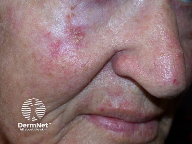 Actinic Keratoses treated with imiquimod