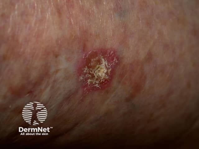 Actinic Keratoses treated with imiquimod