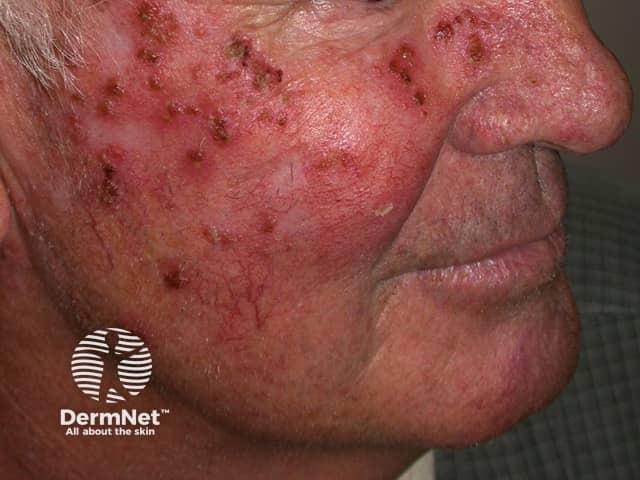 Actinic Keratoses treated with imiquimod