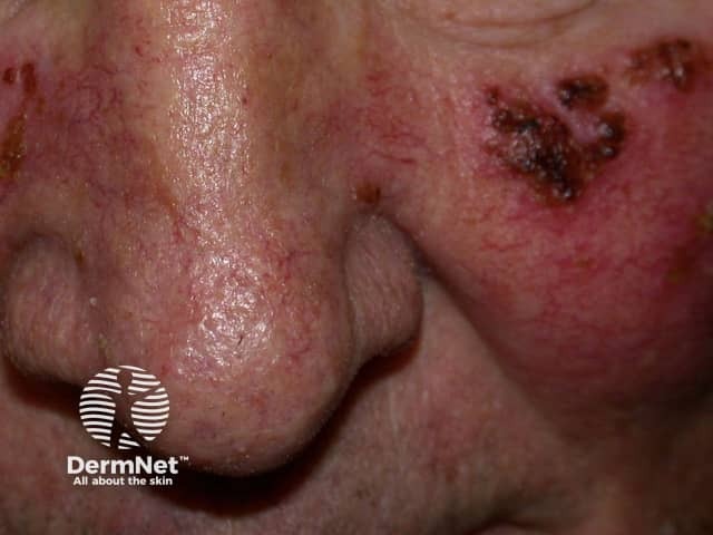 Actinic Keratoses treated with imiquimod