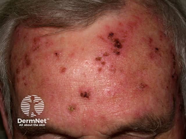 Actinic Keratoses treated with imiquimod