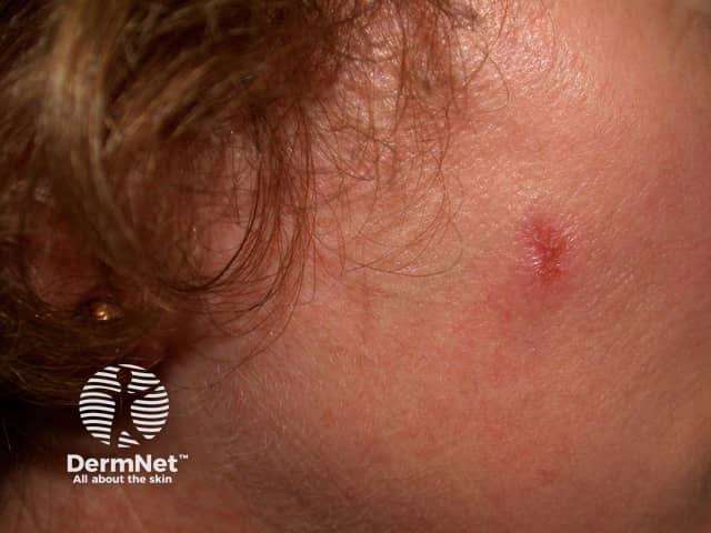 Actinic Keratoses treated with imiquimod