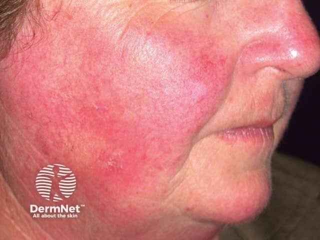 Actinic Keratoses treated with imiquimod