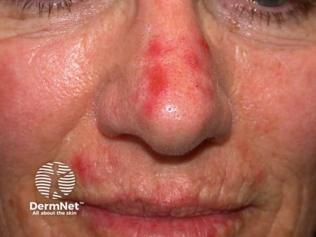 Actinic Keratoses treated with imiquimod