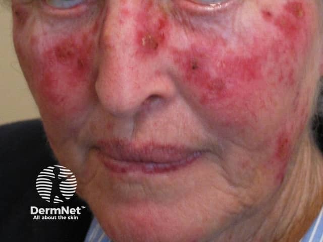 Actinic Keratoses treated with imiquimod