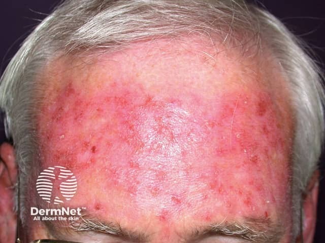 Actinic Keratoses treated with imiquimod