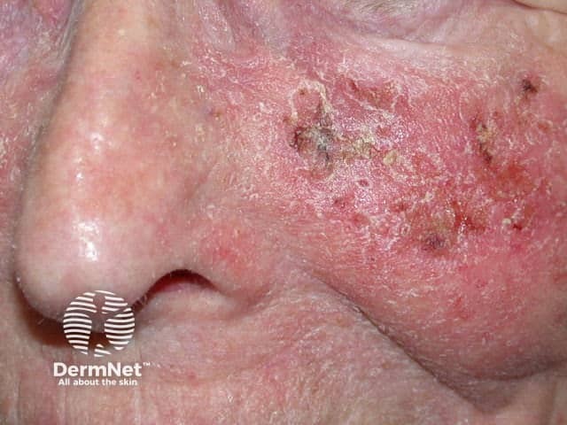 Actinic Keratoses treated with imiquimod