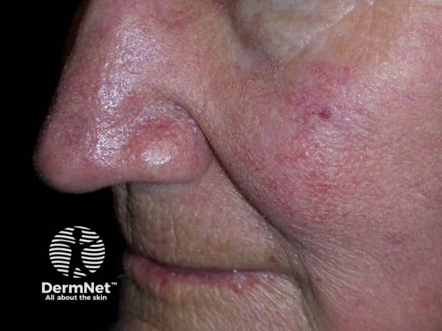 Actinic Keratoses treated with imiquimod