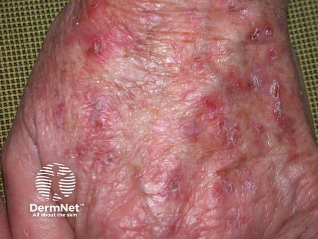 Actinic Keratoses treated with imiquimod