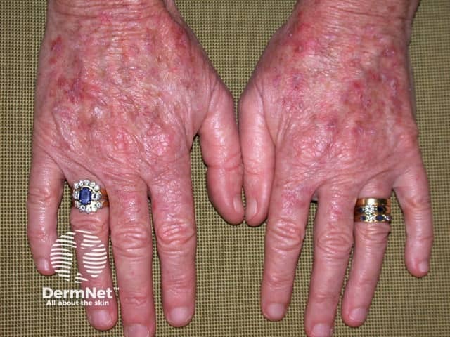 Actinic Keratoses treated with imiquimod