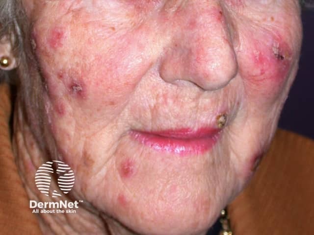 Actinic Keratoses treated with imiquimod