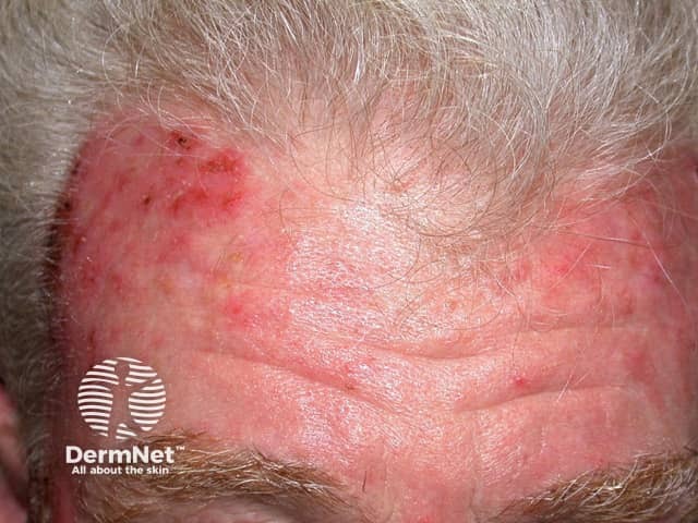 Actinic Keratoses treated with imiquimod