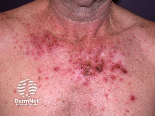 Actinic Keratoses treated with imiquimod