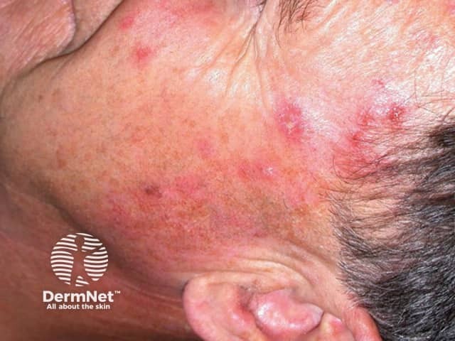 Actinic Keratoses treated with imiquimod