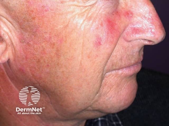 Actinic Keratoses treated with imiquimod